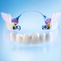 IMEX-Zahnersatz - Herausnehmbarer Zahnersatz - Geschiebeprothese