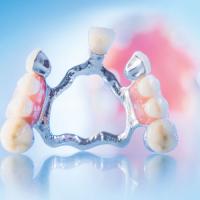 Nachts tragen zahnprothese Top7 Zahnprothesen