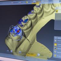 IMEX- CAD/CAM - Zahnersatz - 3D-Zahnmodellage